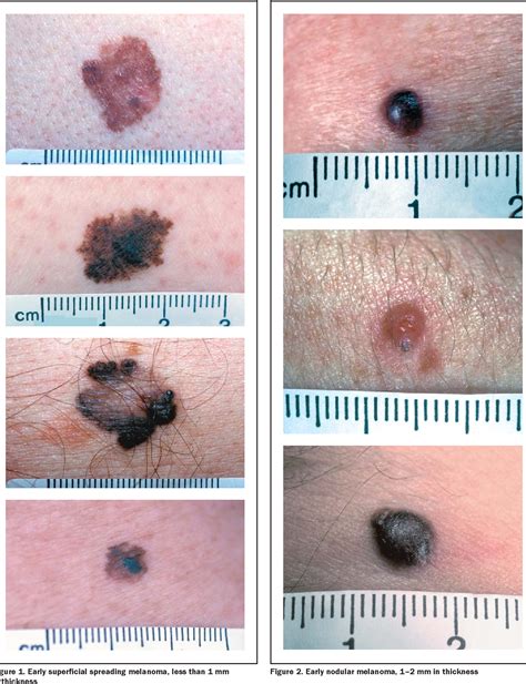 Superficial Spreading Malignant Melanoma