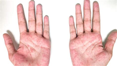 Palmar Erythema: Symptoms and Causes