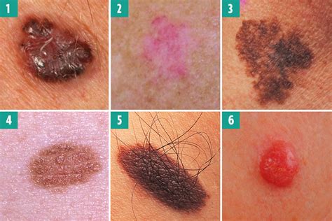 Can you spot the deadly moles from the harmless ones? The skin cancer signs you must never ...