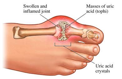 Arthritis Mold Exposure