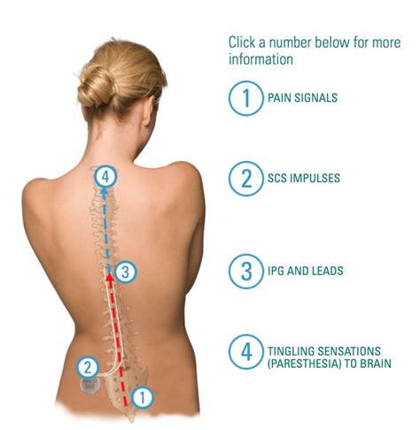 Boston Scientific releases Spinal Cord Stimulator Trial app - iMedicalApps