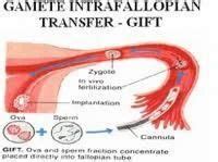 Gamete Intra-Fallopian Tube Transfer at best price in New Delhi