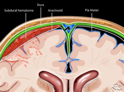 The Radiology Assistant : Traumatic Intracranial Hemorrhage