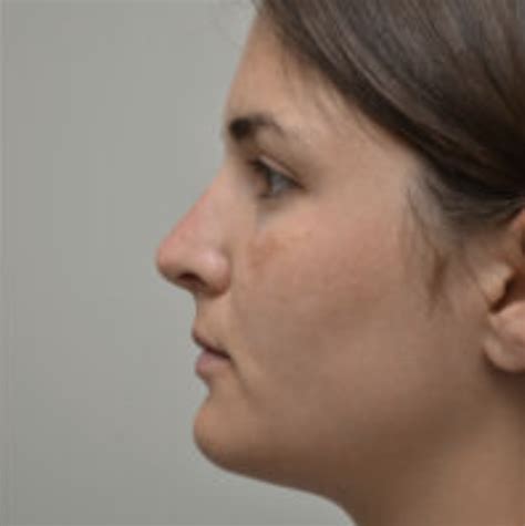 Rhinoplasty Surgery in Albany, NY | The Plastic Surgery Group