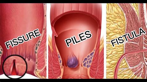 Difference Between Piles, Fissure And Fistula In Kannada, 41% OFF