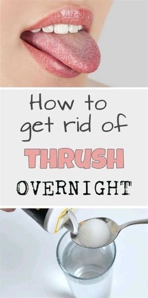 9 Methods for How to Battle Oral Thrush | Home remedies for thrush ...