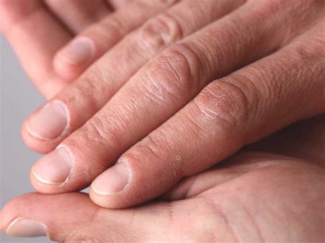 Ridges in Fingernails: Symptoms, Causes, and Treatments