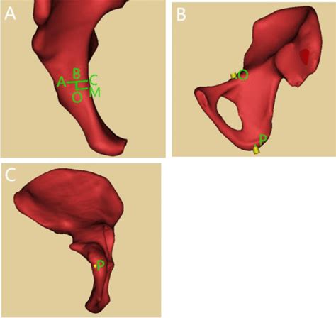 Parameter measurement of all-in screw. 3A: Point A: apex of iliopubic ...
