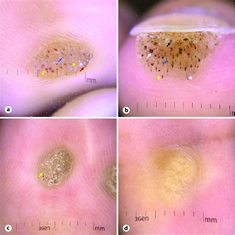 Dermoscopic features of wart lesions at ×10 magnification. a A plantar... | Download Scientific ...