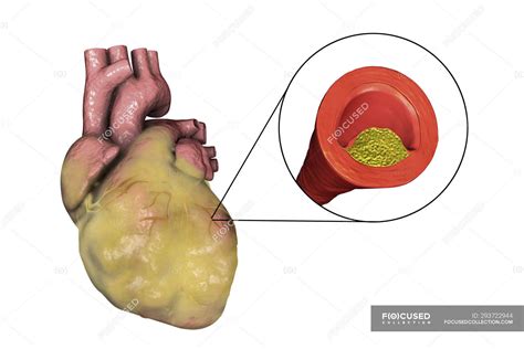 Digitale Illustration des fetthaltigen Herzens und der Herzkranzgefäße, die durch ...