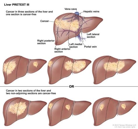 Pin on Liver Cancer Treatment Home Natural Remedies