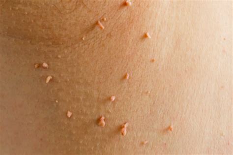 What are Skin Tags - Are they a Sign of Cancer?