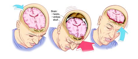 Chronic Traumatic Encephalopathy - The Brain Clinic