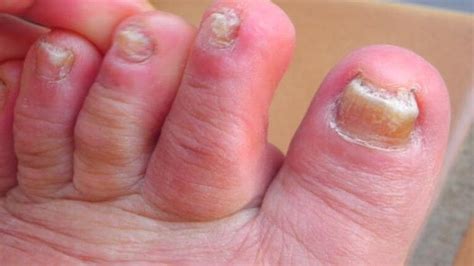 Toenail Fungus Infection – Its Causes, Prevention and Treatment | Stoptazmo