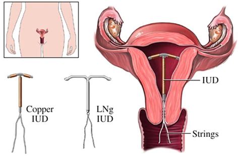 Your Guide to Non-Hormonal Birth Control Part 1: The Copper IUD ...