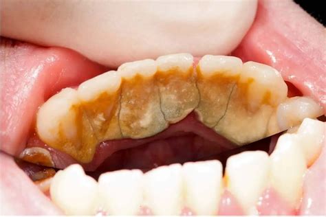 Understanding Plaque And Tartar: Causes, Risks, & Treatment