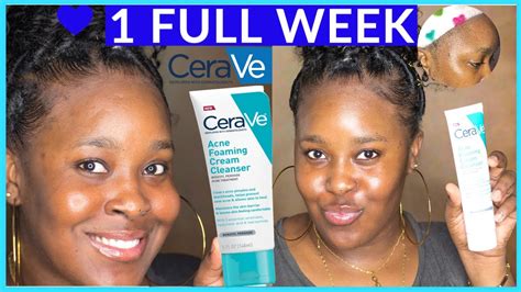 1 WEEK USING CERAVE ACNE FOAMING CLEANSER W/T 4% BENZOYL PEROXIDE ...