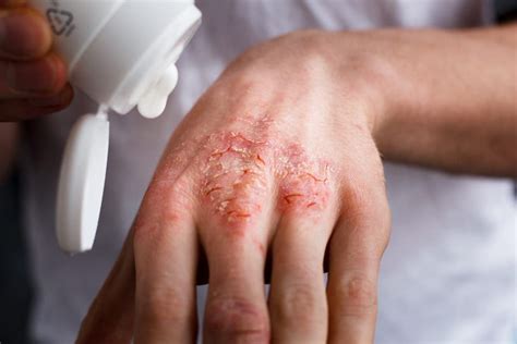 Eczema Symptoms Treatment And Causes - vrogue.co