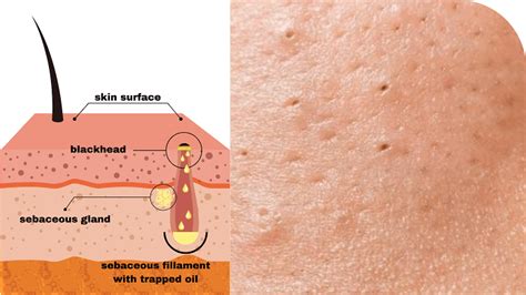 How To Get Rid Of Sebaceous Filaments On Breasts ️ Tried & True