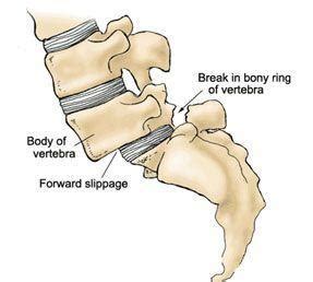 Anterolisthesis - What is?, Grading 1, Treatment, Causes, Symptoms