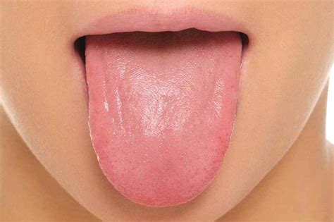 15 Common Tongue Diseases That Can Affect You