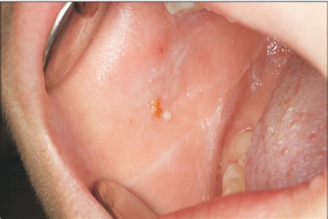 Figure 2 from Treatment of Morsicatio Buccarum by Oral Appliance: Case Report | Semantic Scholar