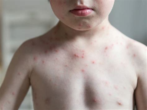 Skin Rashes In Children