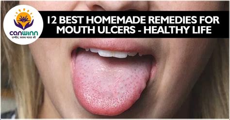 12 Best homemade remedies for mouth ulcers - Healthy Life - Canwinn