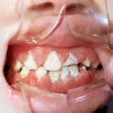 Gingivitis: diseases of the oral cavity in children
