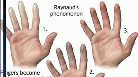 Raynaud's Disease: Symptoms, Causes And Treatments | Faculty of ... Raynaud's Disease, Disease ...