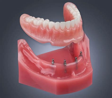 Mini Implants - Dental Clinic in Istanbul - Dentallaid