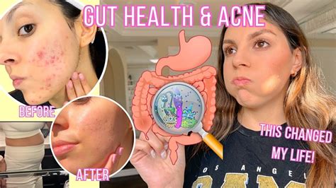 How I Cleared My Skin Through Gut Health | Gut Health & Acne - YouTube