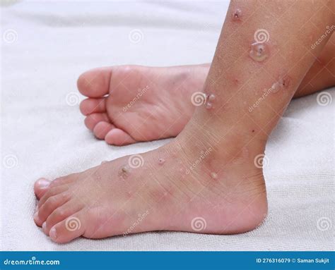 Hfmd Hand Foot Mouth Virus Red Blisters on Both Legs and Feet Epidemic ...