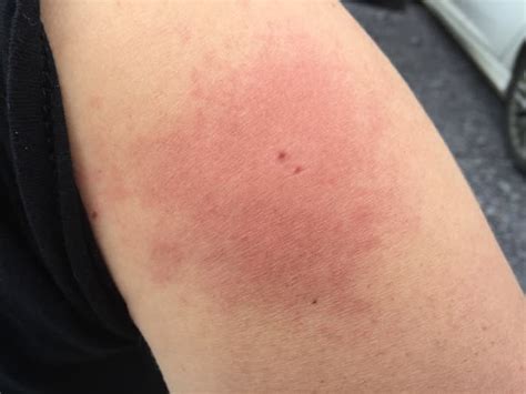 Negative Reaction to a Horsefly Bite: My Recovery Experience - Patient ...