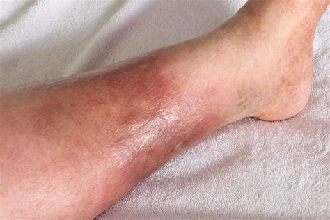 Cellulitis Signs, Symptoms, And Diagnosis, 57% OFF