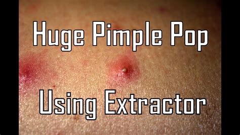 Huge Pimple Pop Using Extractor - Back Zit - YouTube