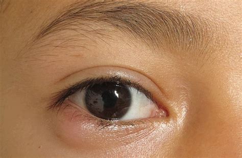 Papilledema (Optic Nerve Swelling)