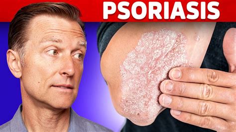 Psoriasis Treatment – The Best 3 Remedies for Psoriasis – Dr.Berg - Vidude