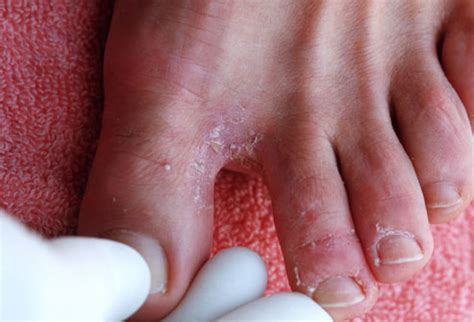 Fungal Skin Infections | New Health Guide