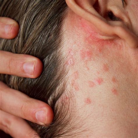 What triggers a shingles outbreak? - Plantation Dermatology