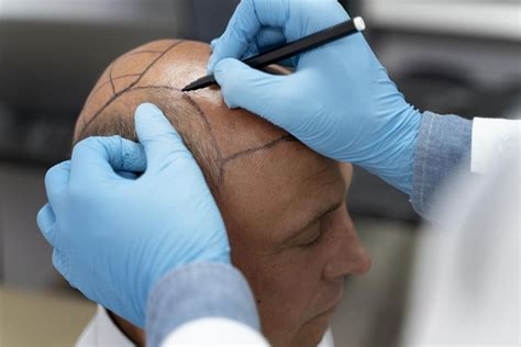 The benefits of hair follicle transplant near me