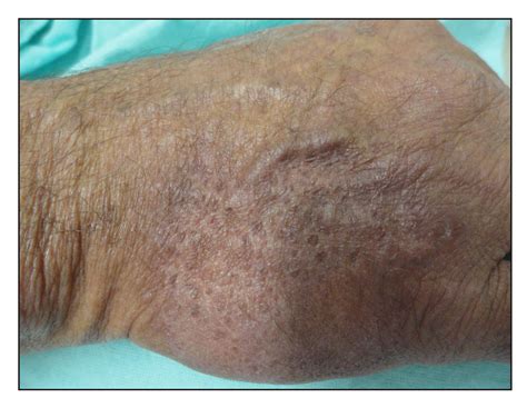 Figure 3 from An atypical presentation of erythema elevatum diutinum | Semantic Scholar