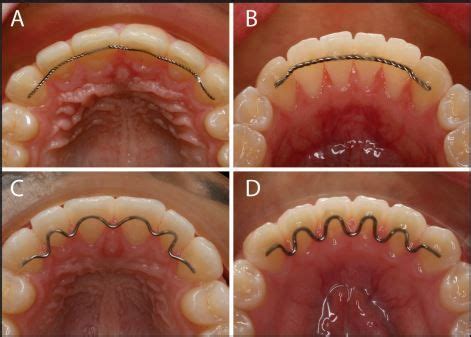 Orthodontic Bonded Retainers | Permanent retainer, Orthodontics, Retainers