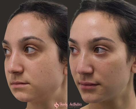 Chin Fillers - Before & After Results at Skinly