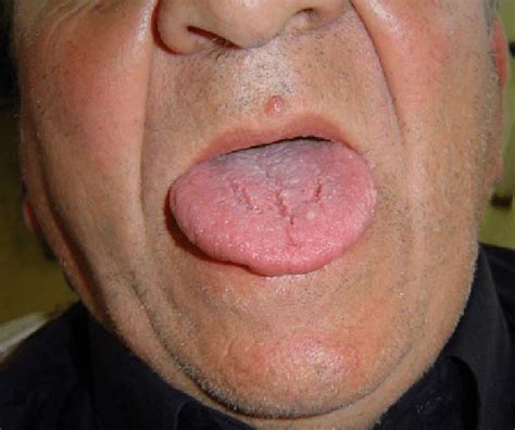 Hpv Lesion On Tongue