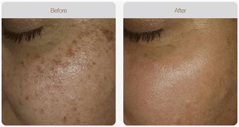 IPL for Pigmentation • Clear Skin • NASCENT Skin & Beauty Clinic