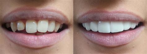 Veneers: What’s in a Beautiful Smile? - Hutto Hippo