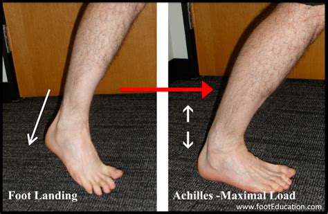 Achilles Tendon Exam