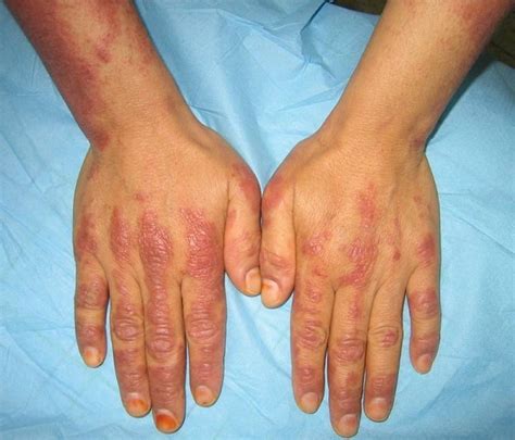 Dermatomyositis: Causes, Symptoms, Diagnosis, Treatment, & More ...