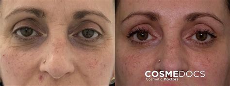 Baby Botox Before and After photos and results